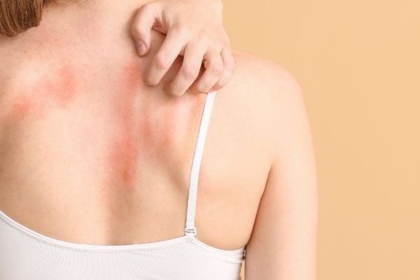 Medyczna Marihuana - leczenie stanów zapalnych i świądu