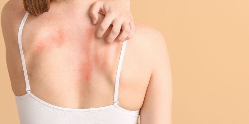 Medyczna Marihuana - leczenie stanów zapalnych i świądu